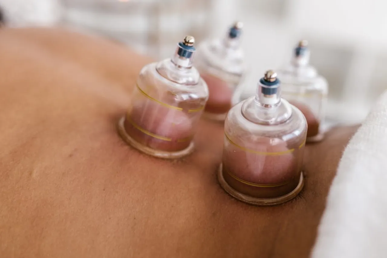 Acupunctuurbehandeling